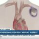 Health Corner: Preventing sudden cardiac arrest