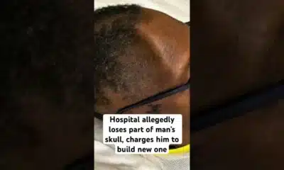 Hospital allegedly loses part of man’s skull