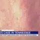 State confirms 1st measles case in TN since 2019
