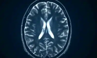 Doctor gets TMS approved for teens