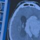 Case of Meningococcal Disease confirmed at Houston ISD’s Bonham Elementary School