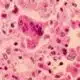 What to know amid the Texas measles outbreak | NBC4 Washington