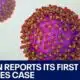Measles: Infant in Austin tests positive for virus | FOX 7 Austin