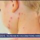 Texas measles outbreak 2025: More new cases detected in West Texas