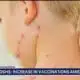 Texas measles outbreak 2025: More new cases detected in West Texas