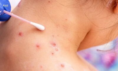 Measles case confirmed in DC, individual may have exposed others on Amtrak train