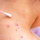 Measles case confirmed in DC, individual may have exposed others on Amtrak train