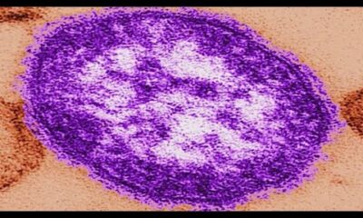 Harris County health department reports measles case in child younger than 18