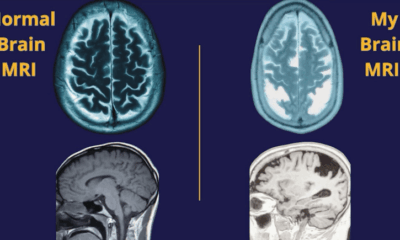 preventing Alzheimer's • Asheville Watchdog