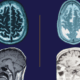 preventing Alzheimer's • Asheville Watchdog