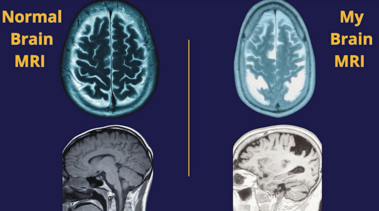preventing Alzheimer's • Asheville Watchdog