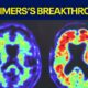 New investigational drug for Alzheimer's disease
