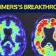 New investigational drug for Alzheimer's disease