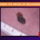 How to lower your risk of skin damage and cancer