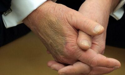 What is Chronic Venous Insufficiency? Will Trump be okay?