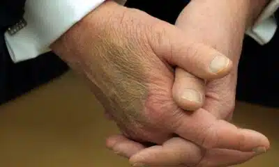 What is Chronic Venous Insufficiency? Will Trump be okay?