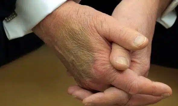 What is Chronic Venous Insufficiency? Will Trump be okay?